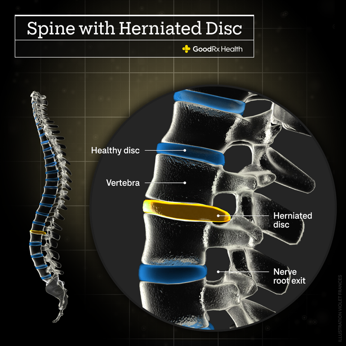 A 3D illustration of a spine with a herniated disc including healthy disc, vertebra, herniated disc, and nerve root exit.