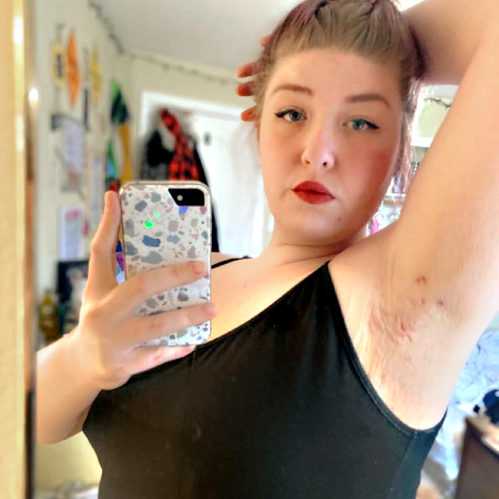 Allicia Thomas is pictured in a selfie, lifting her arm to reveal her skin condition, which is visible in her armpit.