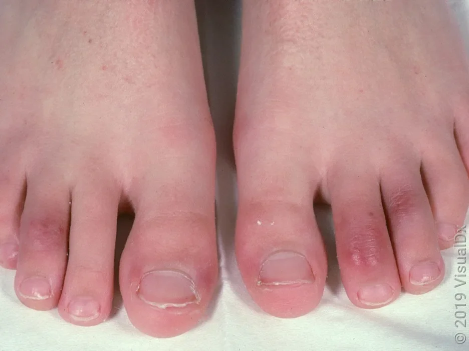 Chilblains on the tops of the toes over the distal and middle phalanges and next to the nail fold of the great toe.