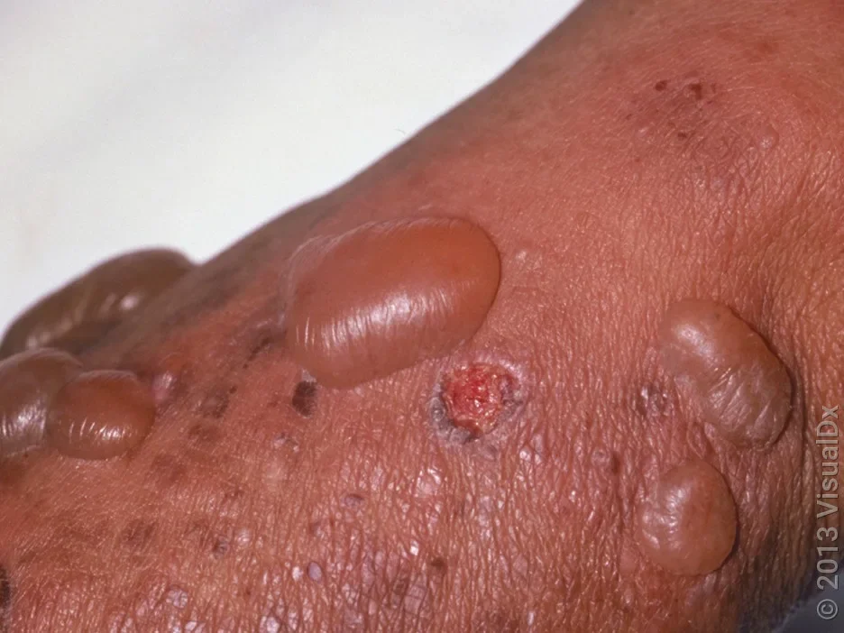 A cluster of fluid-filled blisters. One blister has ruptured.