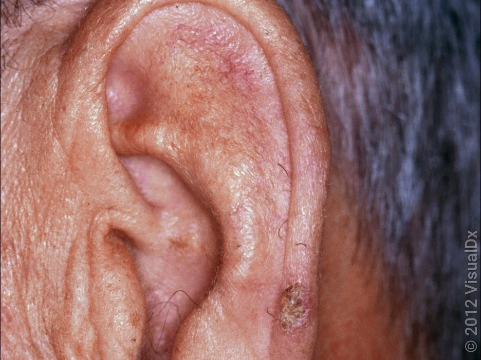 Close-up of an actinic keratosis on the ear.