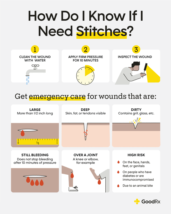 Do I Need Stitches What You Need To Know Goodrx