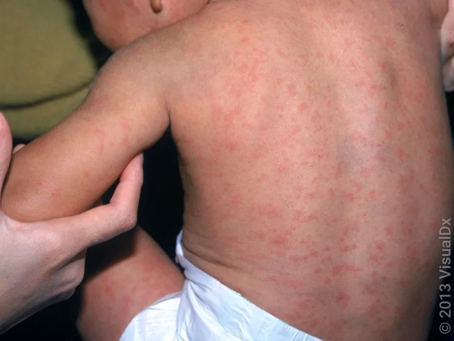 Rubella on the face and body of a child.
