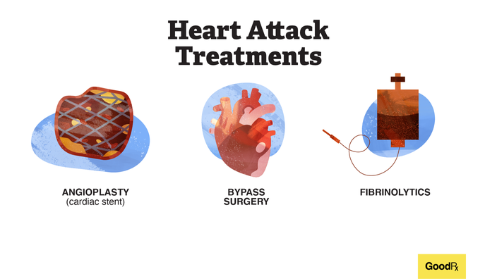 Angioplasty (cardiac stent), Bypass surgery, Fibrinolytics