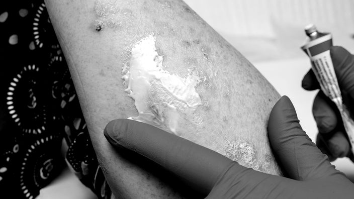 Black and white close-up of a gloved hand applying ointment to a bad poison ivy rash on someone's forearm.