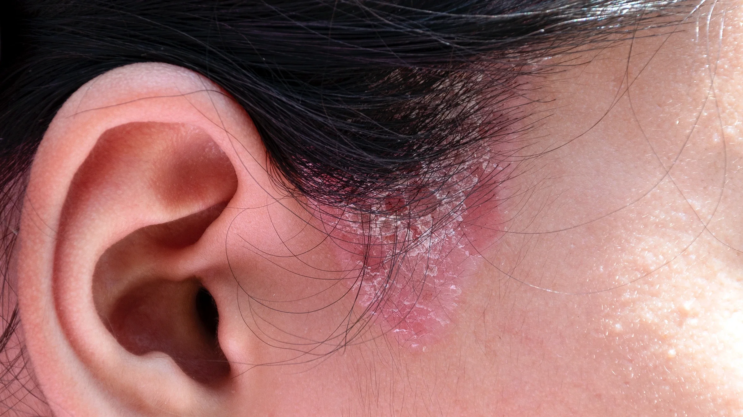 A close-up shot shows a woman with psoriasis on the sideburn area of her hairline.