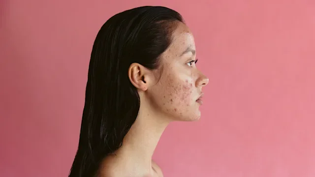 Acne: woman adult acne pink background 1326434325