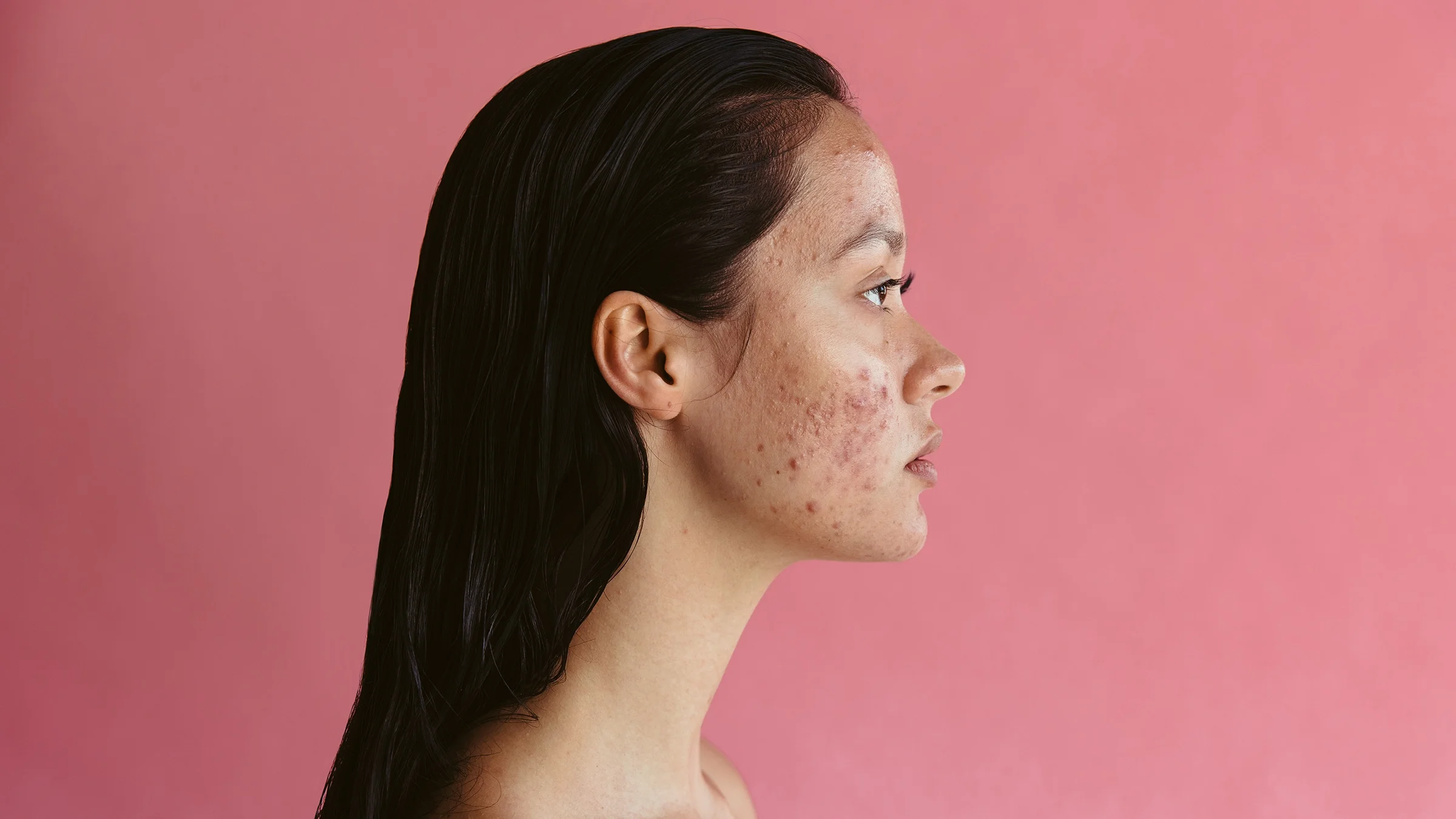 The side profile of an adult with acne, on a pink background.