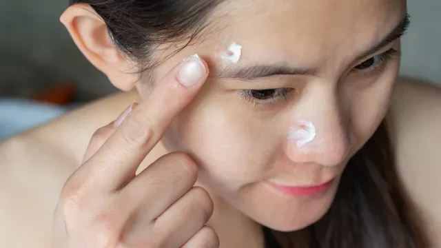 Benzoyl Peroxide vs. Salicylic Acid for Acne