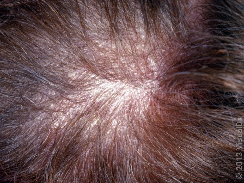 Close-up of thick dandruff flakes on the scalp.