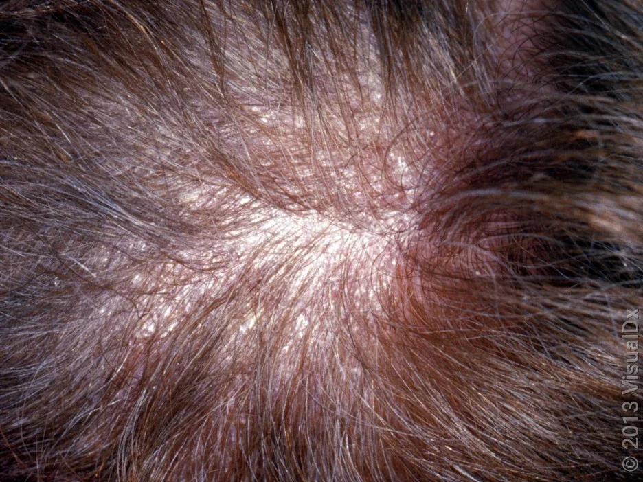 Close-up of thick dandruff flakes on the scalp.