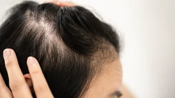 Methotrexate: closeup hair loss 2193045858