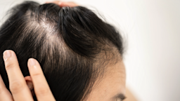 Yes, methotrexate can cause hair loss. However, hair loss is an uncommon side effect, and your hair should grow back after treatment. Learn more with this guide.