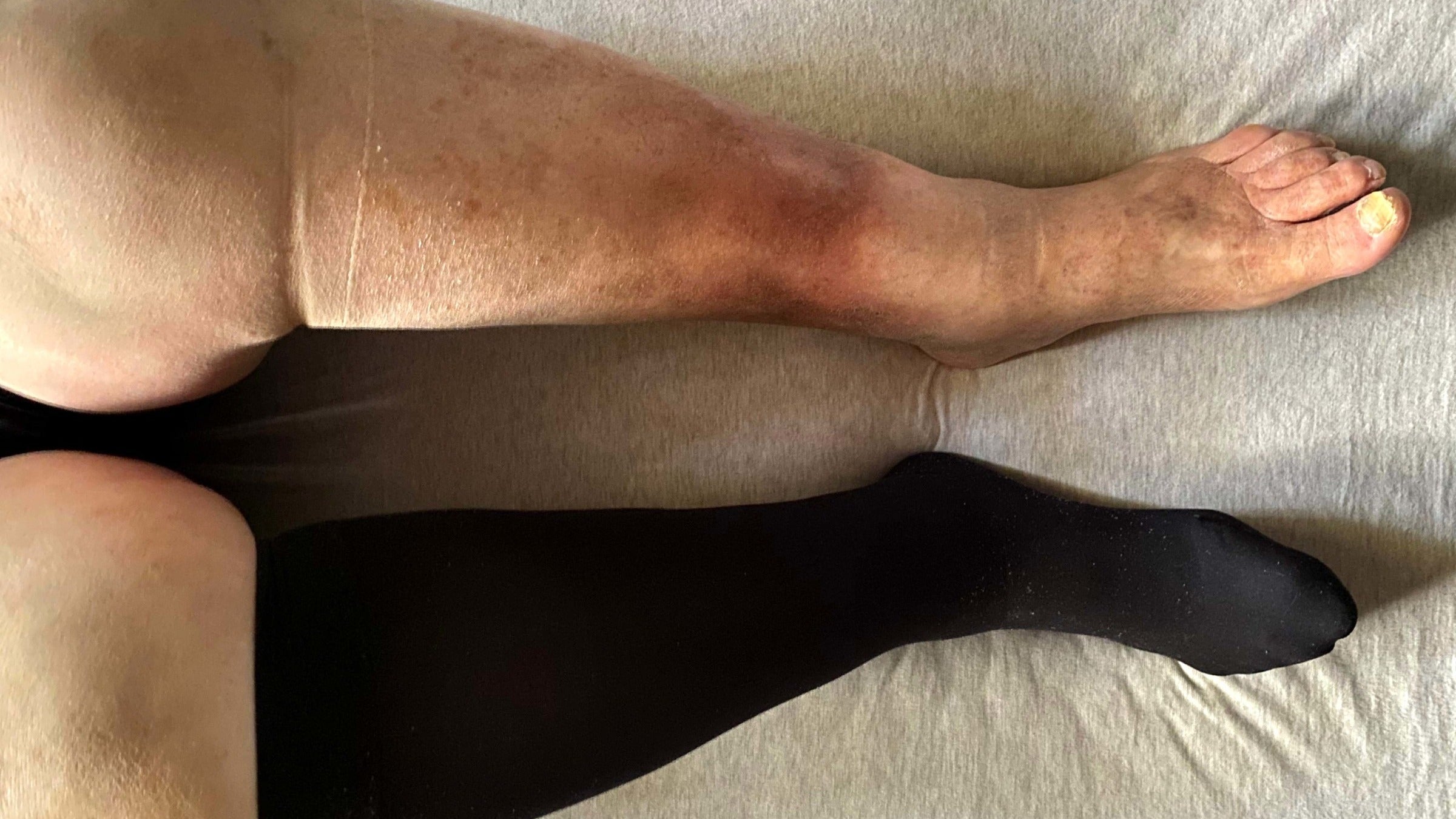 Cellulitis leg shop