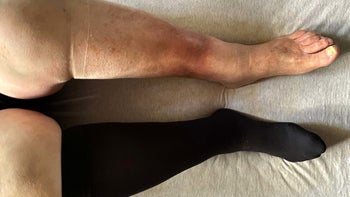 Health: Skin Infection: shutterstock 1904485369 2