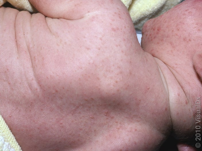 Many tiny red and white bumps on the cheek, neck, and back of an infant with baby acne.