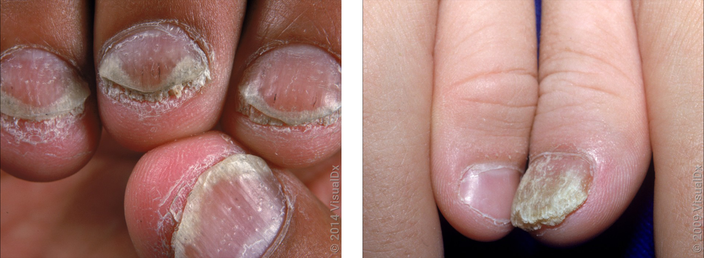 Left: Close-up of thickened nails in psoriasis. Right: Close-up of a thickened and misshapen nail in psoriasis.