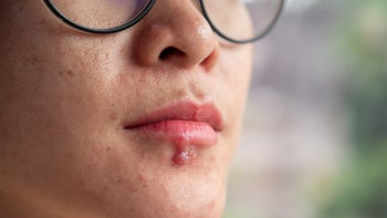 Dermatology: closeup cold sore 1344004757