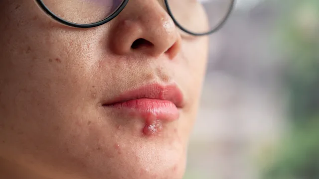 Dermatology: closeup cold sore 1344004757