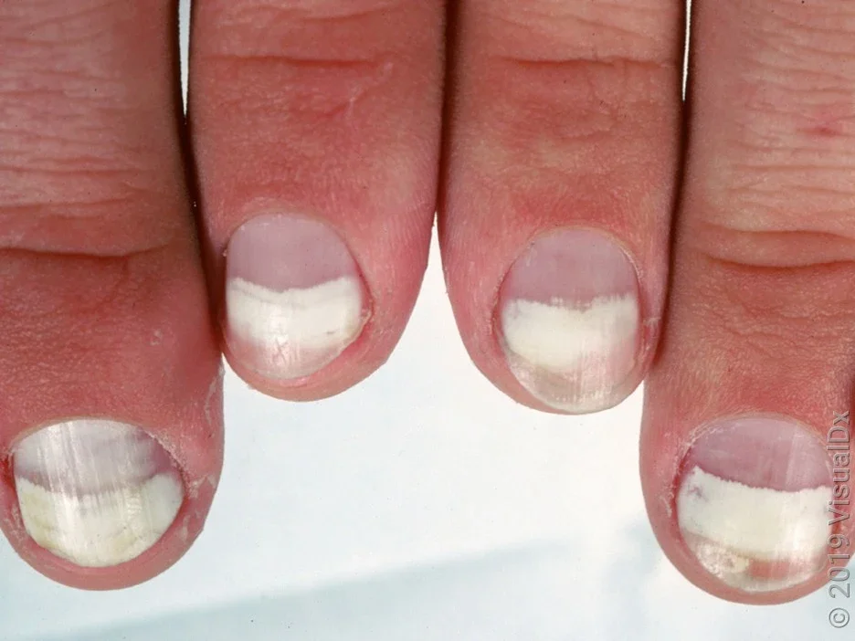 Fingernails with broad, transverse white lines.