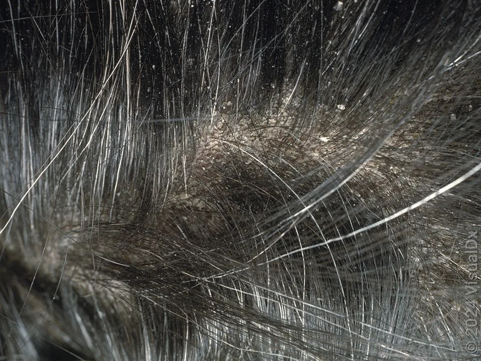 Close-up of scalp with small, white flakes from dandruff.