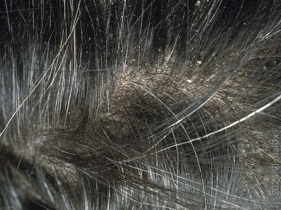 Close-up of scalp with small, white flakes from dandruff. 