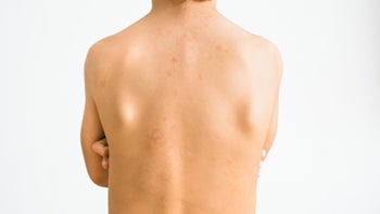 Dermatology: close up child back with pityriasis rosea GettyImages 1284997405