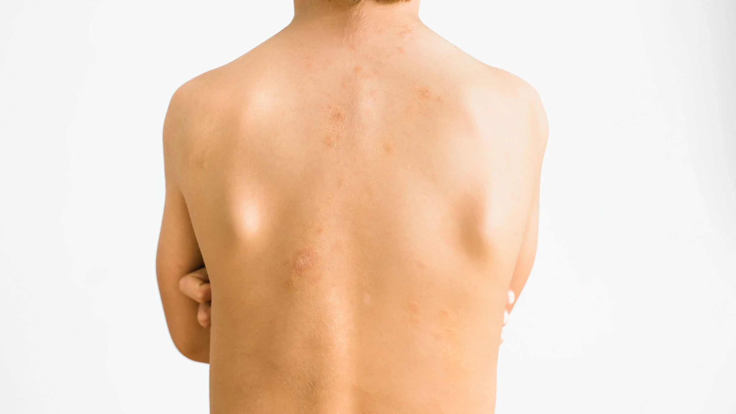 Close up of child's back with pityriasis rosea.
Joaquin Corbalan/iStock via Getty Images

