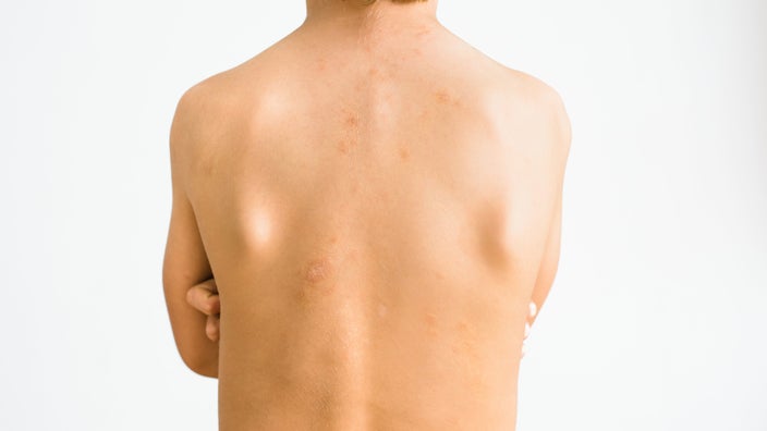 Close up of child's back with pityriasis rosea.