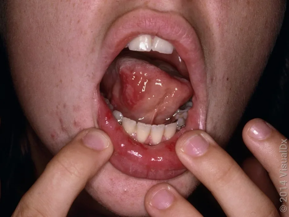 Hand, foot, and mouth disease on the face and in the mouth. 