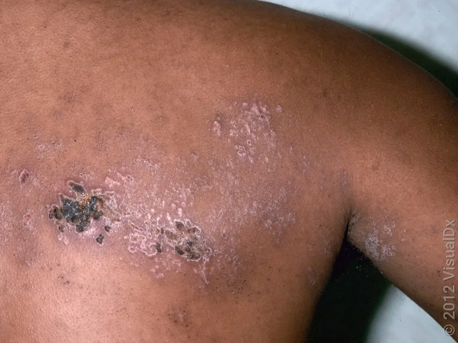 Close-up of the final stage of shingles, which can lead to scars and post-inflammatory hyperpigmentation. 
