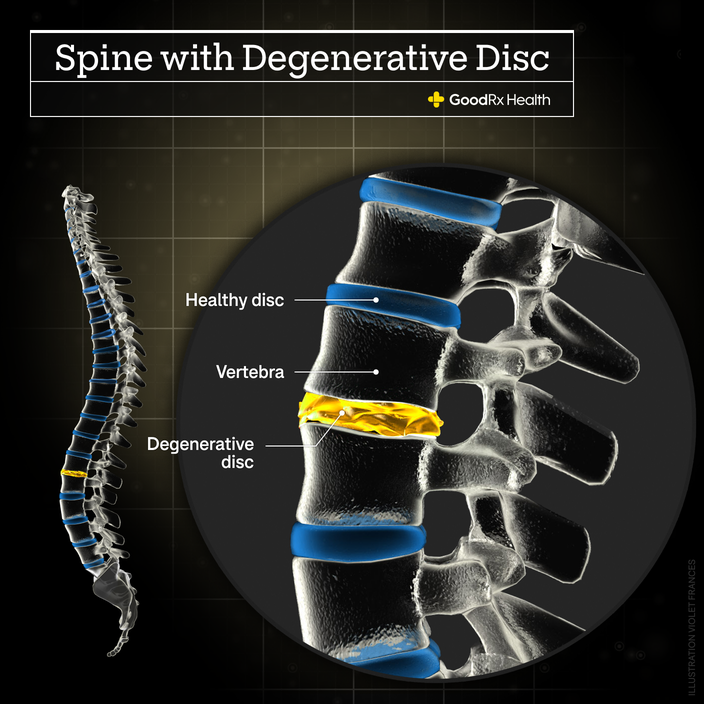 A 3D illustration of a spine with a degenerative disc including healthy disc, vertebra, and degenerative disc.
