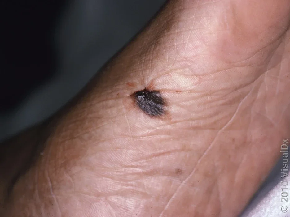 Close-up of a melanoma on Black skin on the side of the foot.