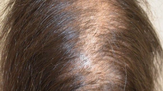 I Tried Harklinikken, the Buzzy Scandinavian Hair-Growth System