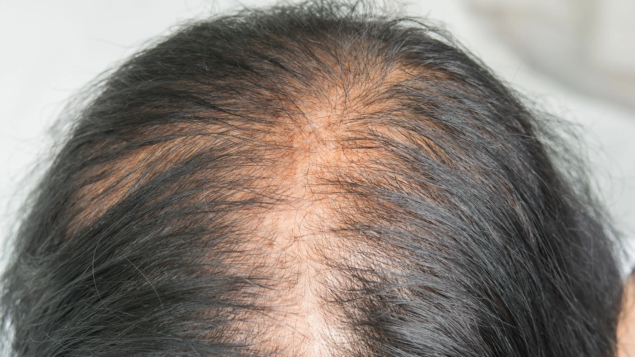 Close-up of a woman's scalp showing female pattern baldness.
Srisakorn/iStock via Getty Images