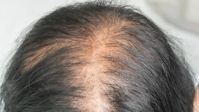 Female-Pattern Baldness: Causes and Treatments for Hair Loss in Women
