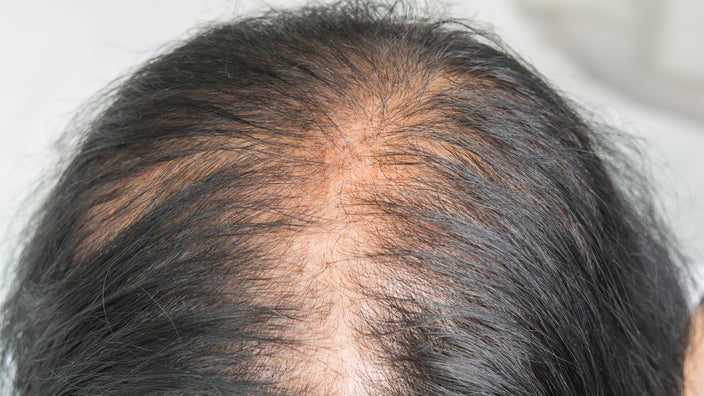 Female-Pattern Baldness: Causes, Treatments, and More - GoodRx