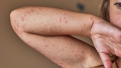 If you’re allergic to an antibiotic, your skin may show the first signs of the reaction. Here’s what an antibiotic rash from amoxicillin or other meds look like.