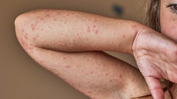 allergies: rash: arm: cropped womans arm allergic rash-1337085512