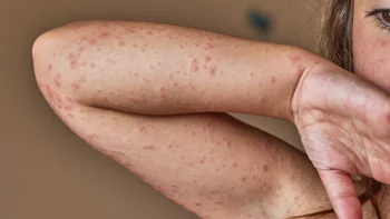 allergies: rash: arm: cropped womans arm allergic rash-1337085512