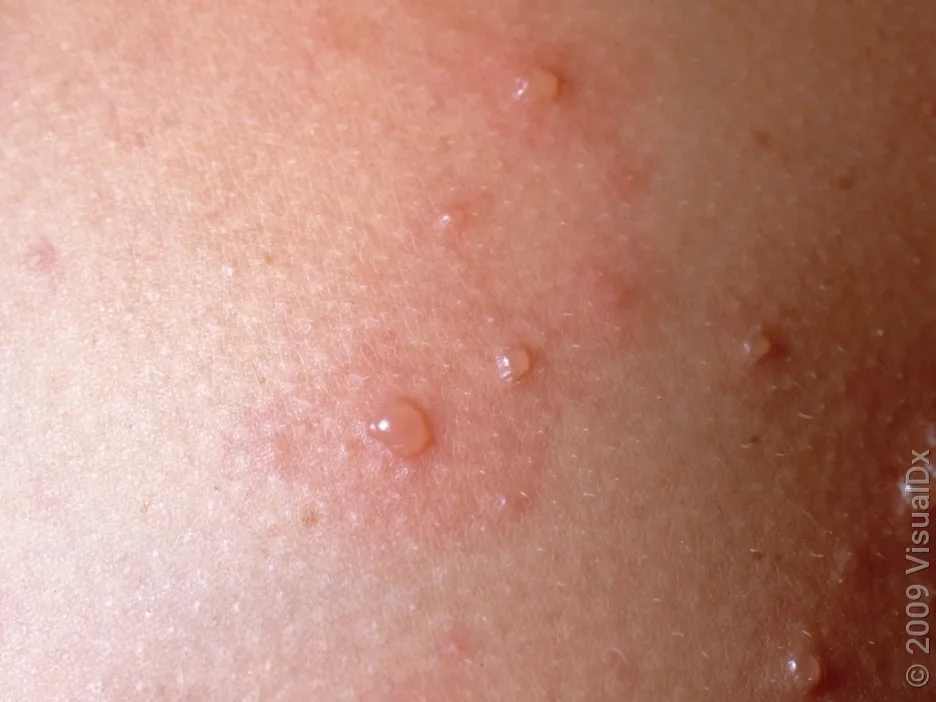 A close-up look at chickenpox blisters. 