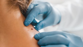 Health: Atypical mole: closeup dermatologist mole 1266812413