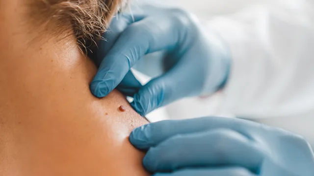 Health: Atypical mole: closeup dermatologist mole 1266812413