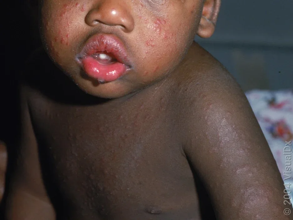 11 Common Rashes on Kids and Preschoolers (With Images) - GoodRx