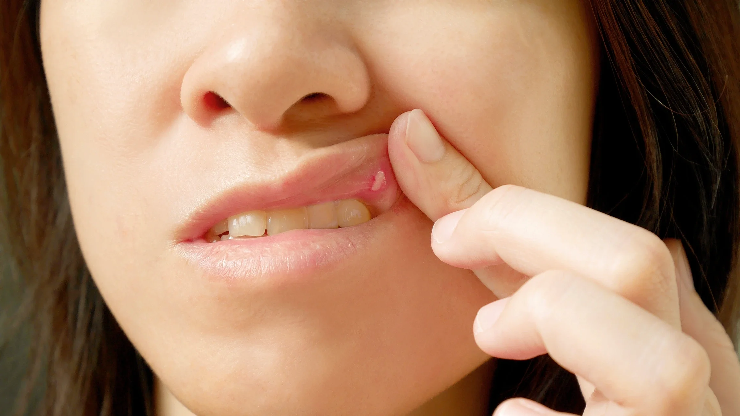Cropped close-up of a woman lifting up her upper lip to expose her canker sore.