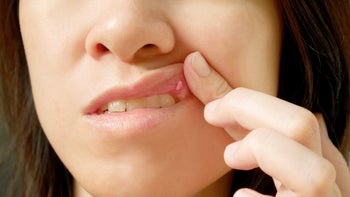 Health: Canker sores: closeup inside lip canker sore-659939632