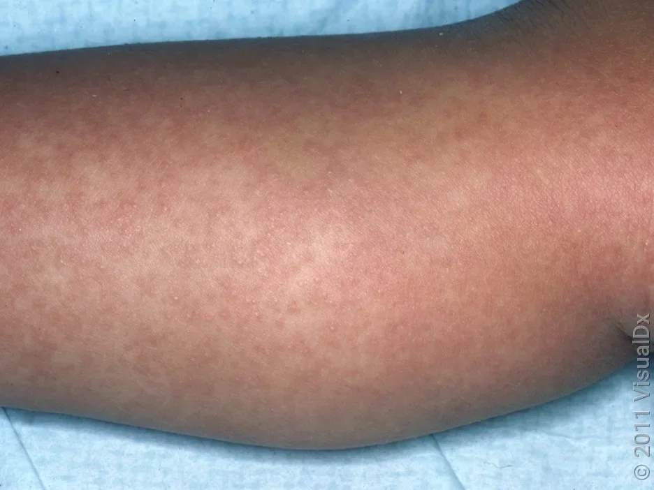Close-up of fifth disease rash on the leg. 