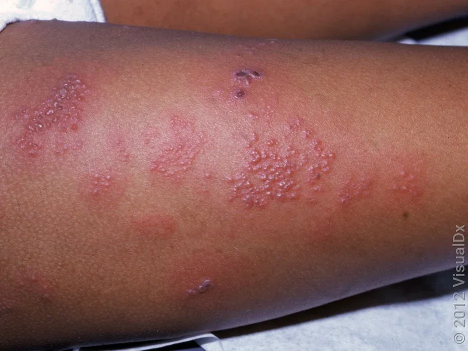Picture of shingles rash on the thigh 