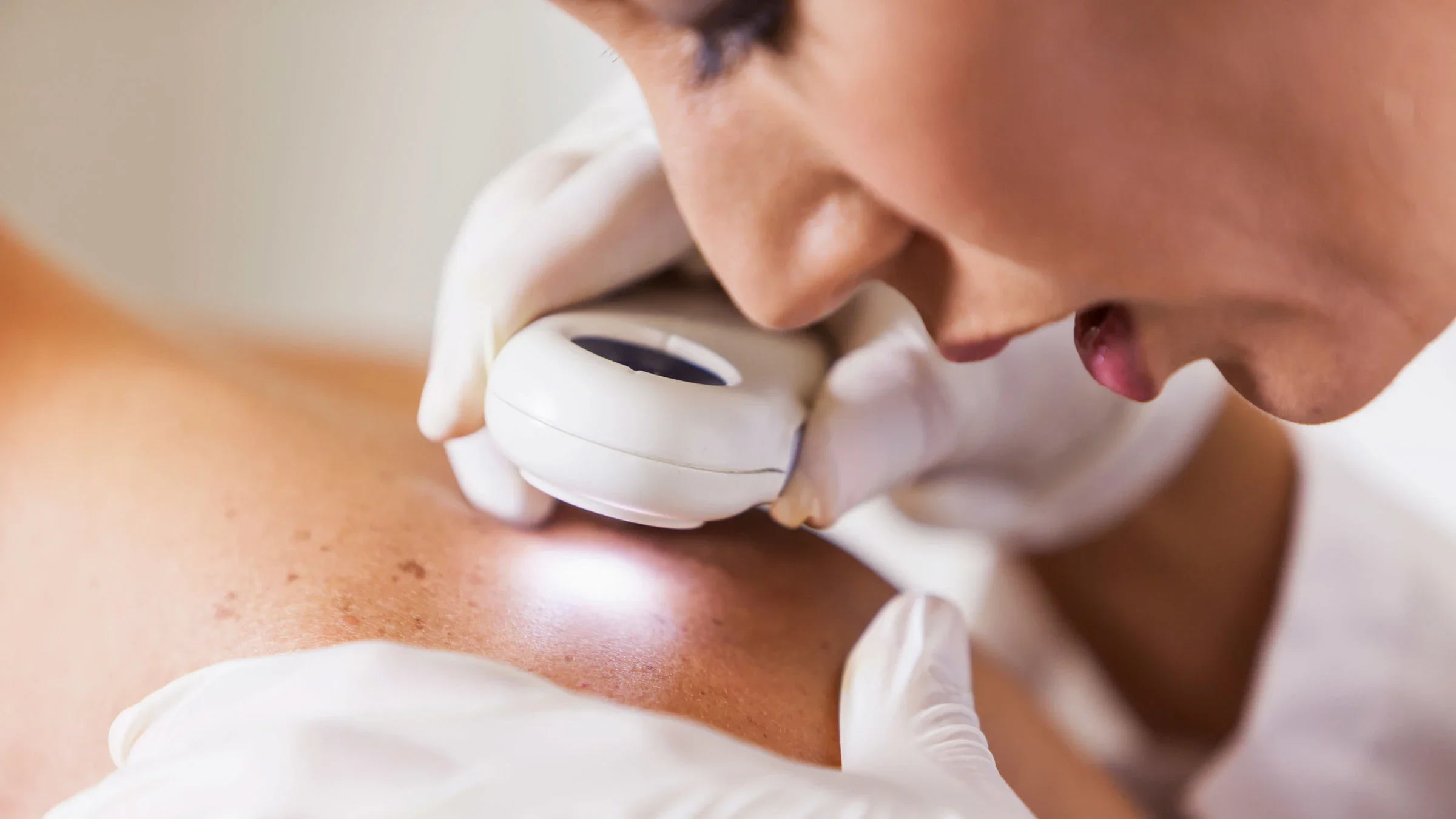 A dermatologist examining skin for melanoma.
kali9/E+ via Getty Images 