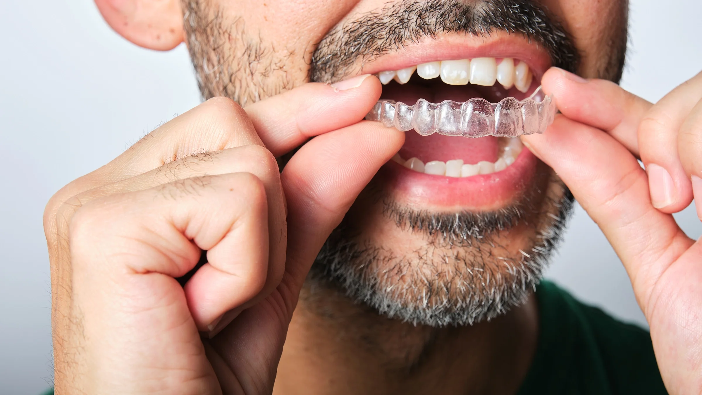 A man gets a clear dental retainer put on. If you're deciding whether to put on braces or clear aligners, take a look at our comparison.